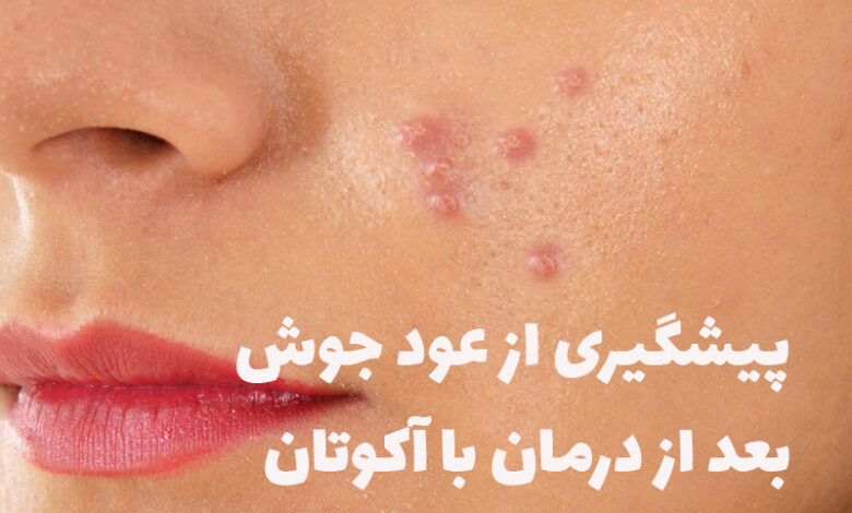 prevention acne after treatment