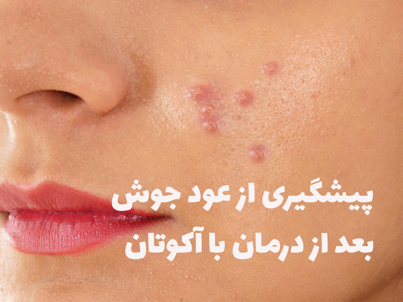 prevention acne after treatment