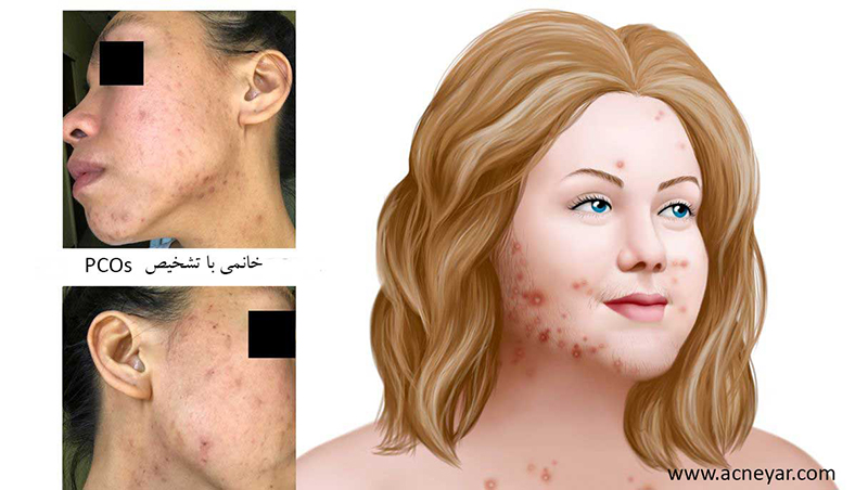 سندروم تخمدان پلی کیستیک چیست؟ و چه ارتباطی با آکنه دارد؟