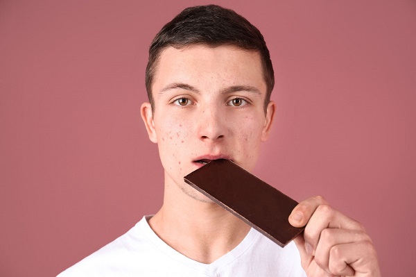 باور غلط درباره جوش - شکلات باعث آکنه می شود؟