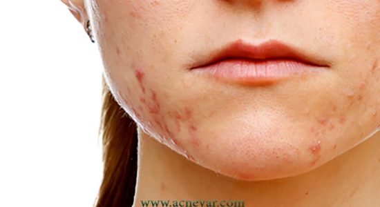 what is acne1